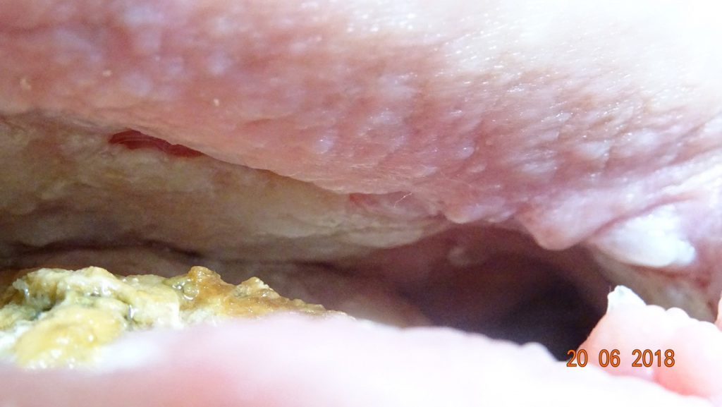 Abscess wound on top of osteomyelitic hip bone. Healthy granulation, healthy skin. 86% reduction in visible wound area. Following MPPT treatment, the soft tissue infiltration, i.e. infection, is now reduced to permit tertiary intention healing, i.e. removal of the infected bone followed by surgical closure of the wound. Septicaemia at start. Sepsis prevented. Pic. 20.06.2018 Cause: Cancer radiation-therapy 35 years prior created an abscess. First misdiagnosed as pressure ulcer / pressure sore.