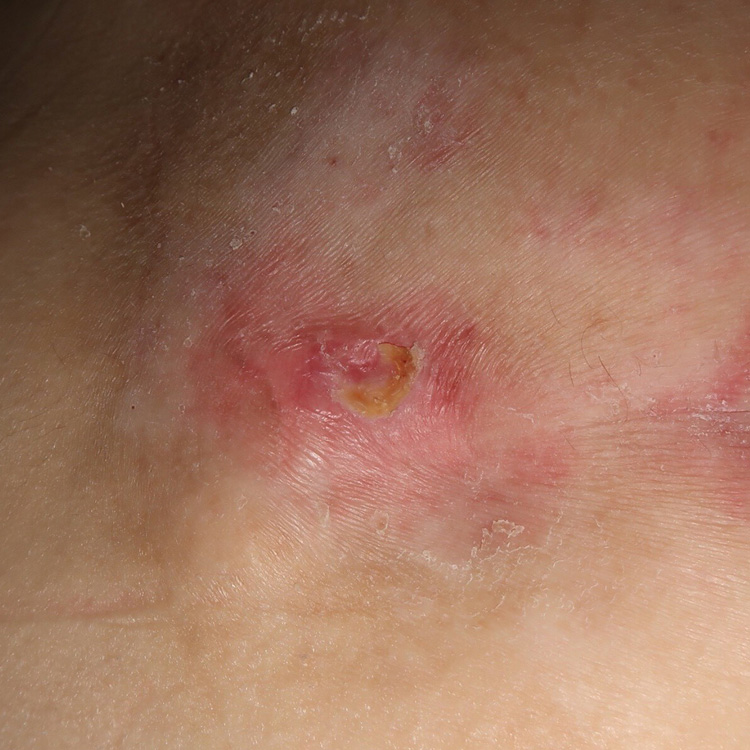 Category 2 pressure ulcer on Day 17 following application of Acapsil once daily for 3 days. The ulcer is closed.