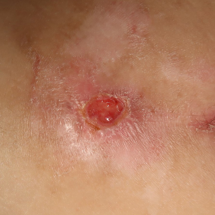 Category 2 pressure ulcer on Day 5 following application of Acapsil once daily for 3 days