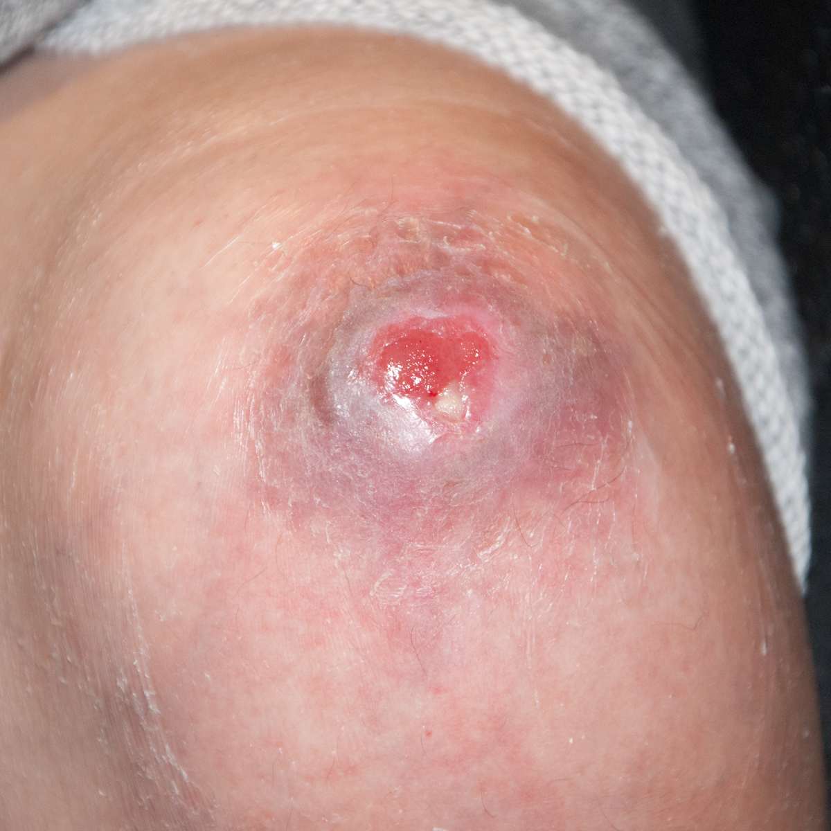 Infected wound on knee