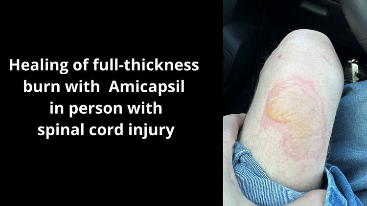 Full-thickness burn in SCI-person